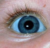 Severe Iron Deficiency Anemia presenting as Blue Sclera.